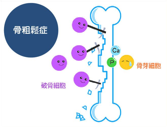 骨粗鬆症イラスト